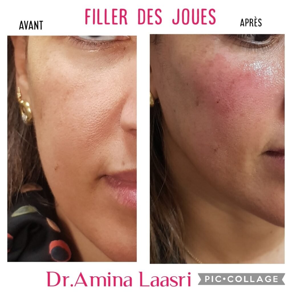 Médecine esthétique - Filler jouesCasablanca