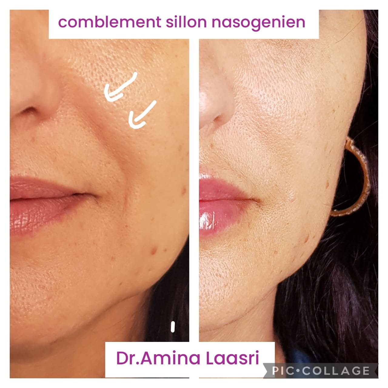 Médecine esthétique - Filler sillons Casablanca
