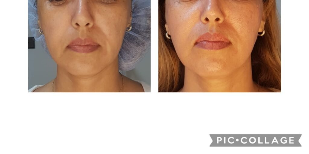 Médecine esthétique - Filler Lèvres Casablanca