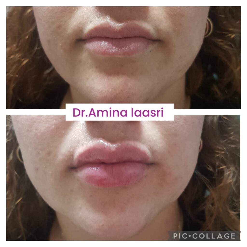 Médecine esthétique - Filler Lèvres Casablanca