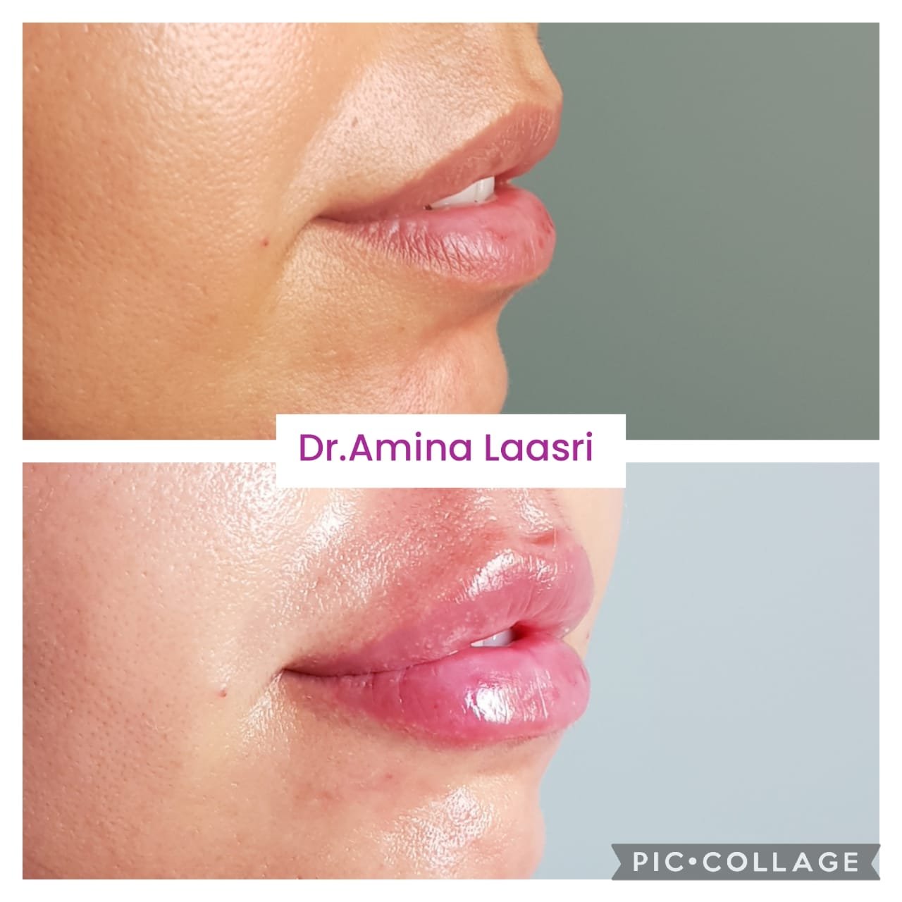 Médecine esthétique - Filler Lèvres Casablanca