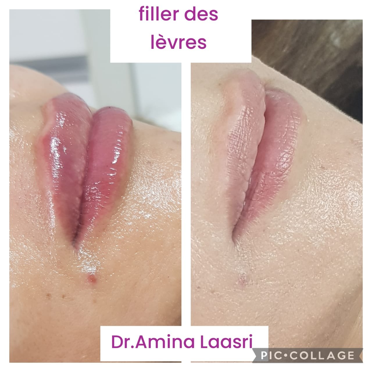 Médecine esthétique - Filler Lèvres Casablanca