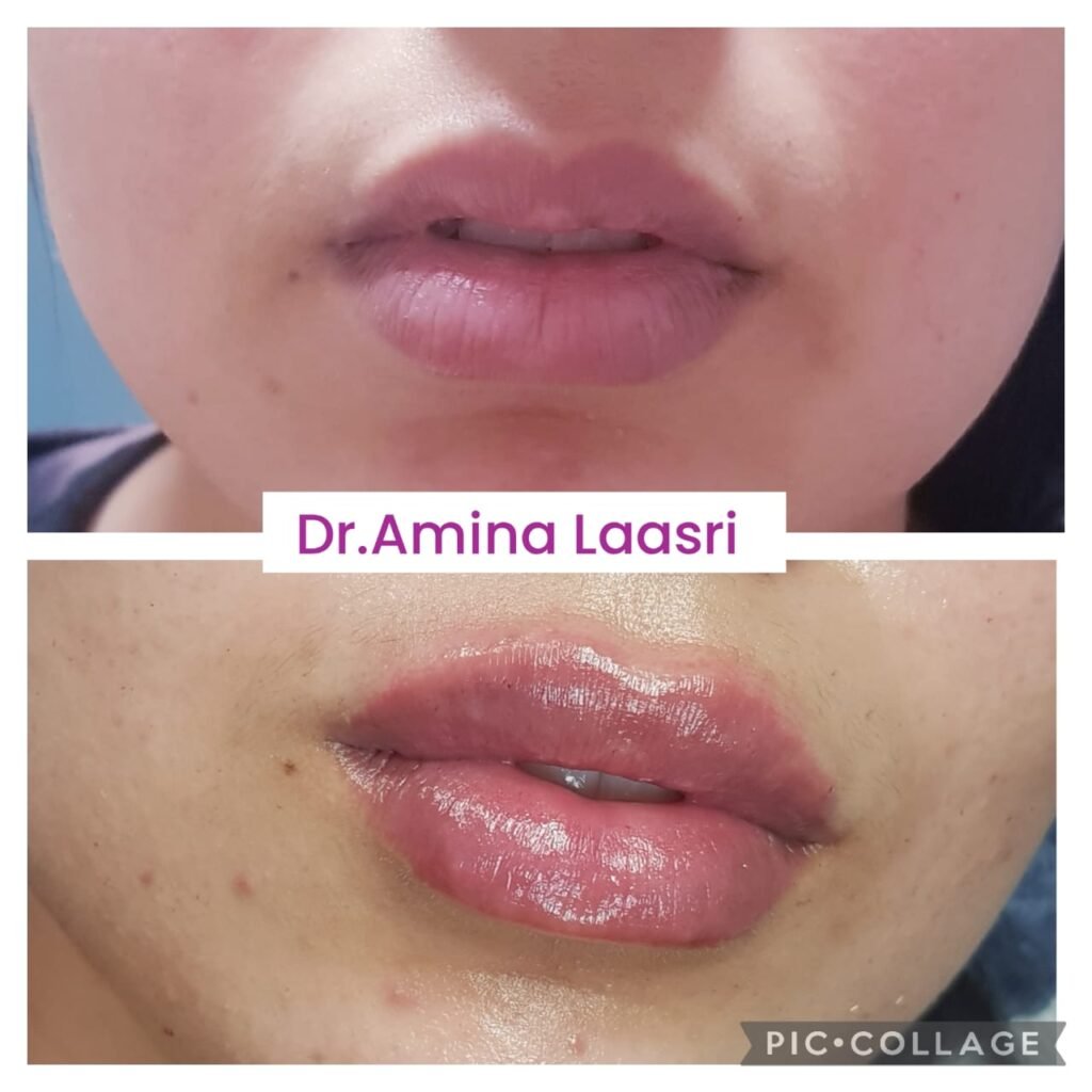 Médecine esthétique - Filler Lèvres Casablanca