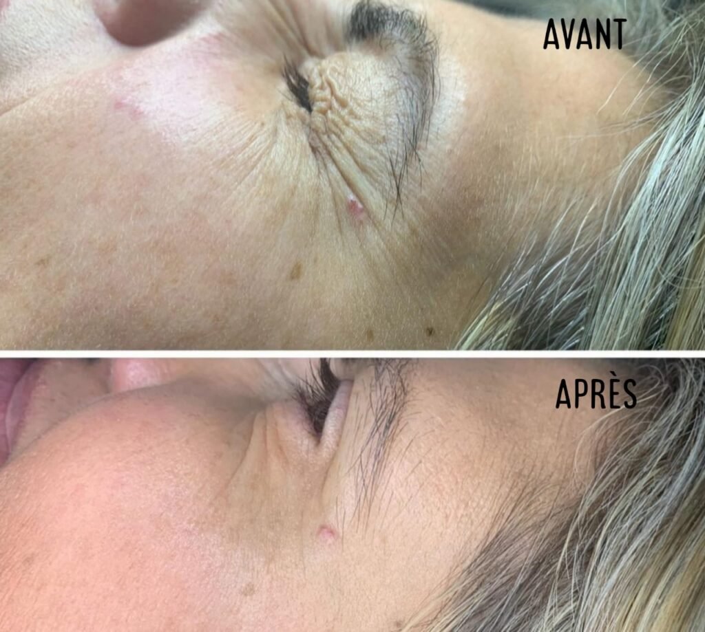 Médecine esthétique - Botox pattes d'oie rides Casablanca