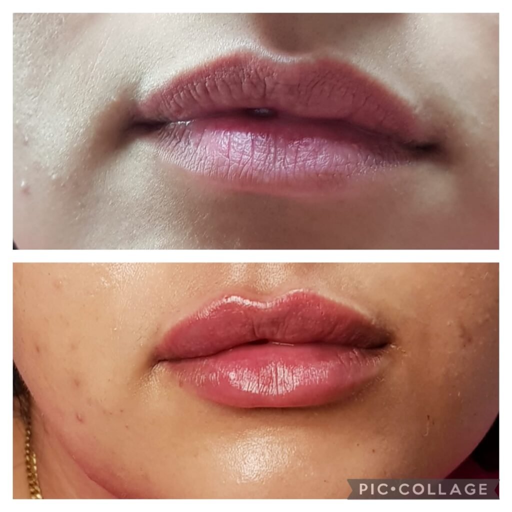 Médecine esthétique - Filler Lèvres Casablanca